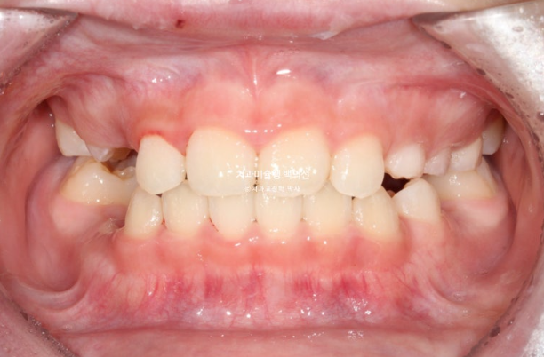 어린이 비대칭 반대교합 주걱턱 인비절라인 퍼스트 프리올소 성장 교정 관련 이미지 20