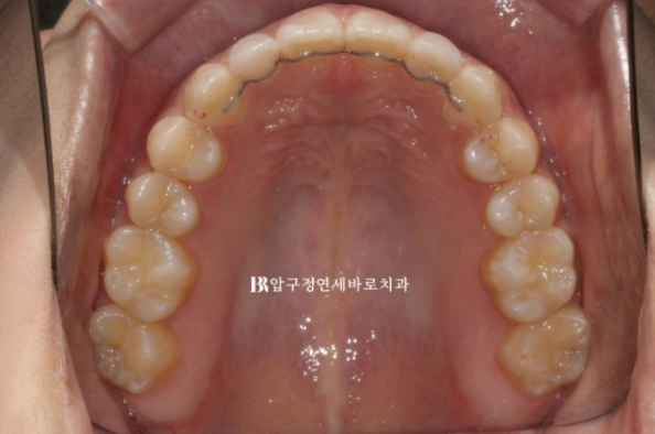 왜소치 인비절라인 라이트 교정 / 무삭제 라미네이트 젤라미 관련 이미지 9