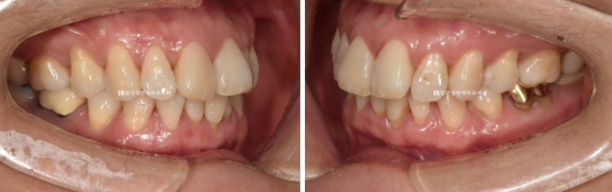 50대 중년교정 인비절라인 라이트 나비치아 교정 앞니 교정 후기 관련 이미지 2