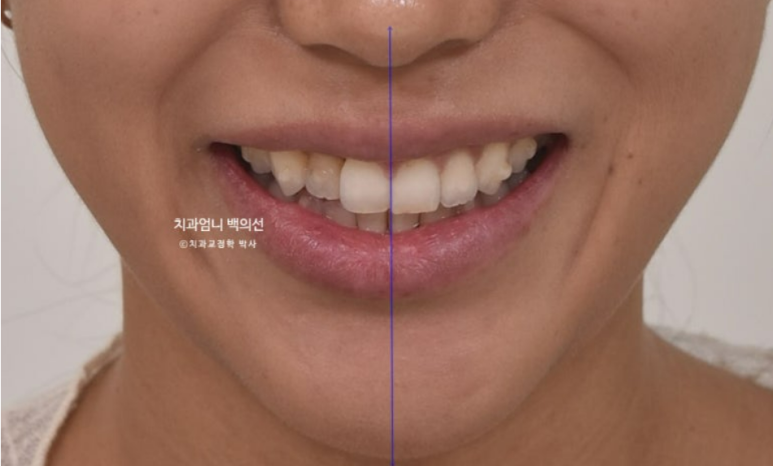 인비절라인 비발치 덧니 교정 반대교합 치료 후기 관련 이미지 10