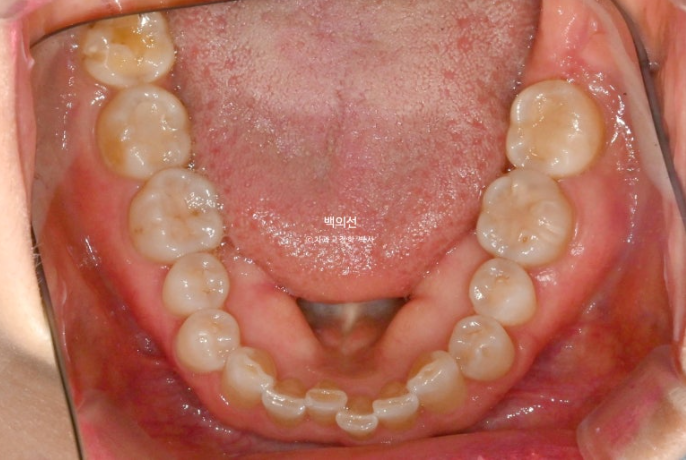 50대 치아교정 :: 인비절라인 익스프레스 치아 벌어짐 단기교정 후기 관련 이미지 6