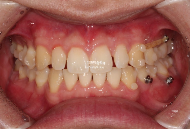비대칭 비발치 거미스마일 잇몸미소 중심선 가위교합치료 무삭제 라미네이트 관련 이미지 10