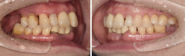 A 60s Patient’s Orthodontic Treatment Review | A Case Combining Partial Orthodontics for the Front Teeth After Periodontitis Treatment with No-Prep Veneers image 3