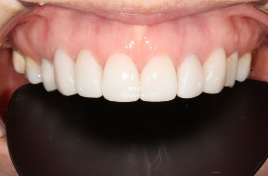 40대 무삭제 라미네이트 블랙트라이앵글 레진 치료 관련 이미지 5