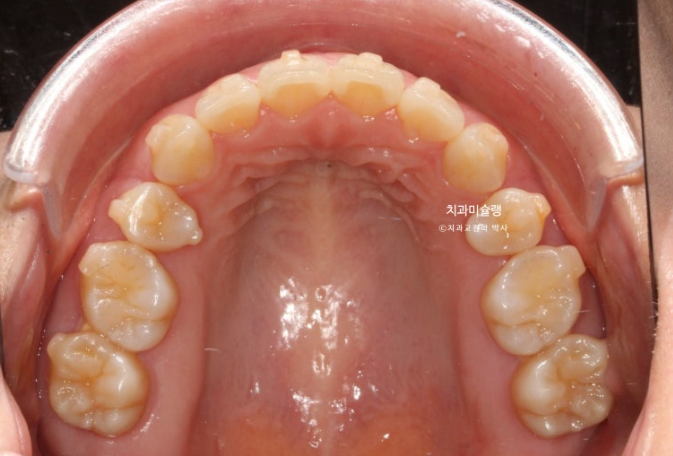 돌출입 덧니 발치 교정 인비절라인 교정 후기 관련 이미지 18