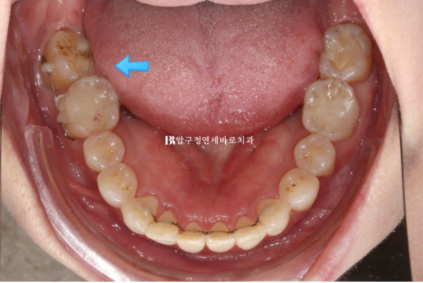 40대 인비절라인 라이트|가위교합도 10개월 만에 개선 가능할까요? 발치 없이 치료한 실제 증례 관련 이미지 12
