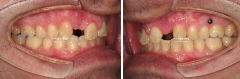 앞니 선천적 결손 인비절라인 임플란트 과개교합 치료 기간 관련 이미지 16