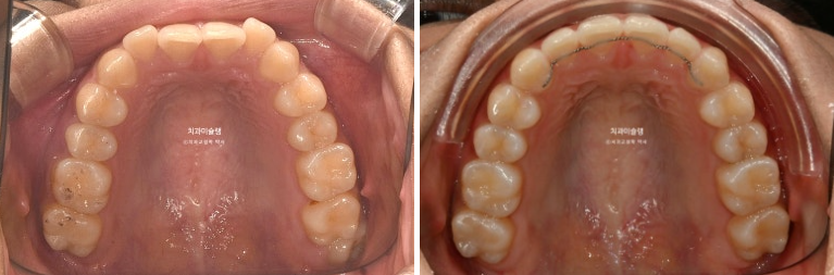 유학생 치아교정 해외거주 한국에서 치아교정? 관련 이미지 15