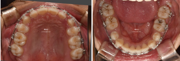 거미스마일 잇몸미소 발치 돌출입 과개교합 교정 후기 관련 이미지 7