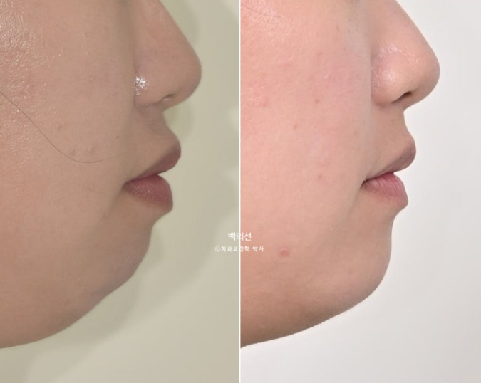 30대 치아교정 돌출입 교정 :: 잇몸미소 거미스마일 교정 입술부전증 결손치 무턱교정 관련 이미지 25