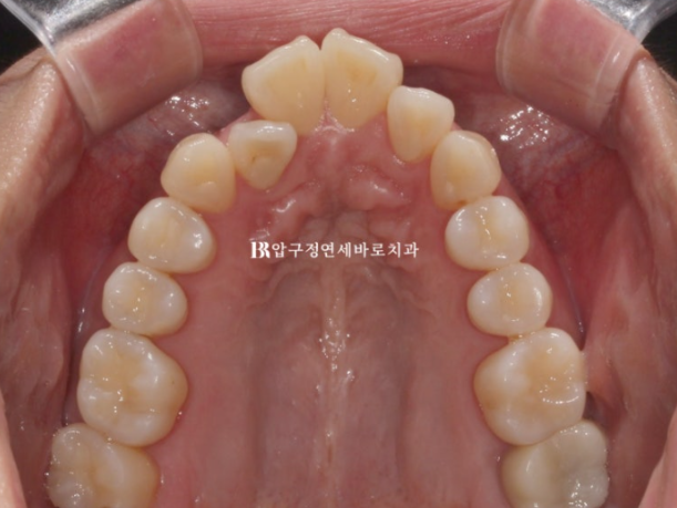 결혼식 6개월 전, 교정 시작해도 될까요? 관련 이미지 6