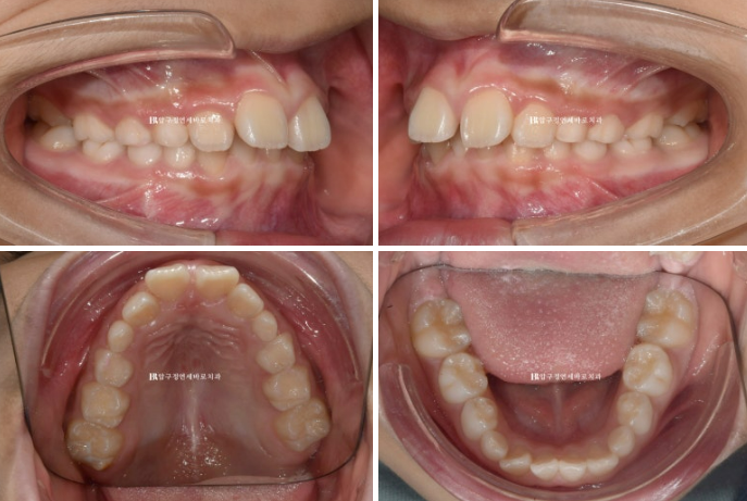 Invisalign First Correction for a Retruded Chin in a Child Orthodontic Treatment for Protrusion image 4