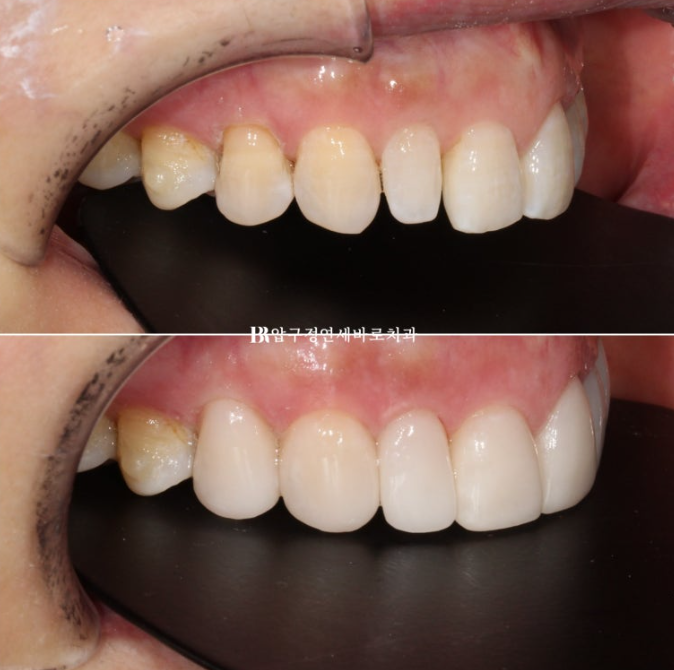 Can It Be Done in Your 50s? Real Results from Limited Front Teeth Orthodontics + No-Prep Laminate Veneers Revealed image 13