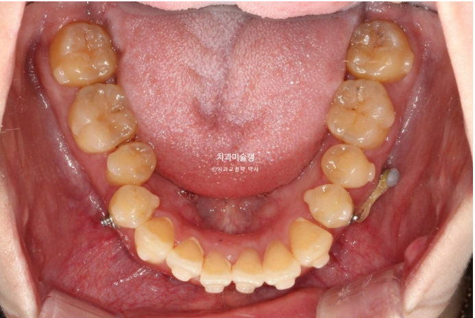 비발치 인비절라인 교정 편측 개방교합 가위교합 돌출 재교정 관련 이미지 11