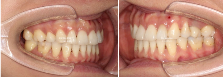 옥니 역교정 재교정 무턱 교정 치료기간 1년 10개월 관련 이미지 14