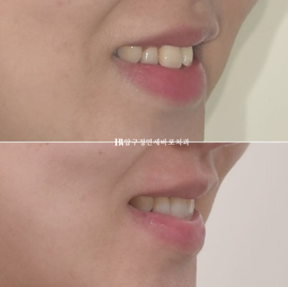 Invisalign Success Depends on Wearing Them Consistently|9-Month Real Treatment Case of Crowding & Underbite image 14