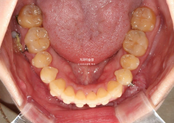 비발치 인비절라인 교정 편측 개방교합 가위교합 돌출 재교정 관련 이미지 15