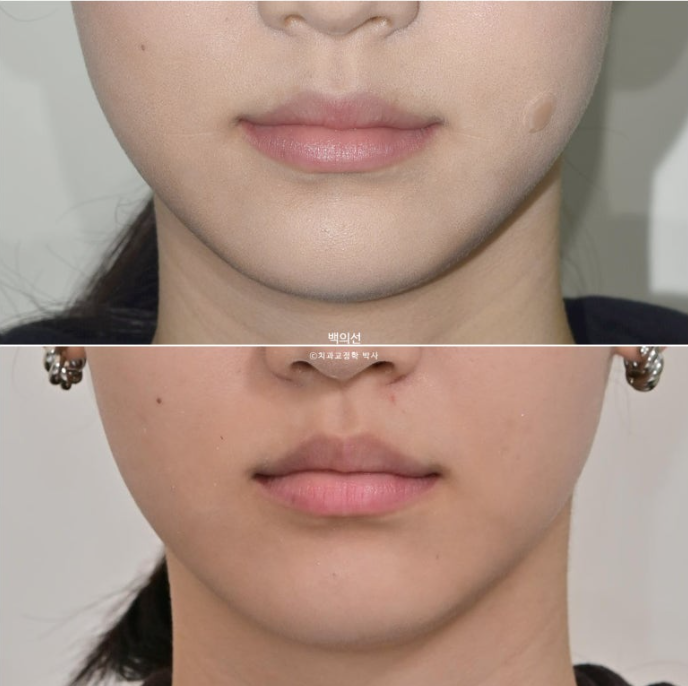 비발치 덧니교정 인비절라인 교정 사랑니 이용 교정 관련 이미지 19