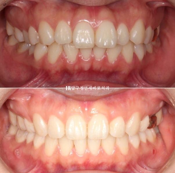 Gummy Smile Correction Review | Natural Improvement of Gummy Smile and Buccal Corridors Through Extraction Treatment for Protruding Teeth image 11