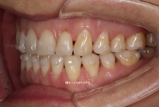 50대 인비절라인 개방교합 합입교정 미니스크류 관련 이미지 13