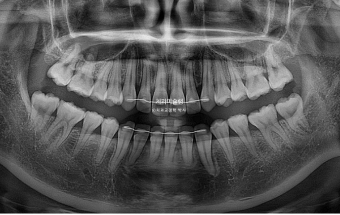 덧니 인비절라인 라이트 잇몸미소 거미스마일 중심선 블랙트라이앵글 관련 이미지 23