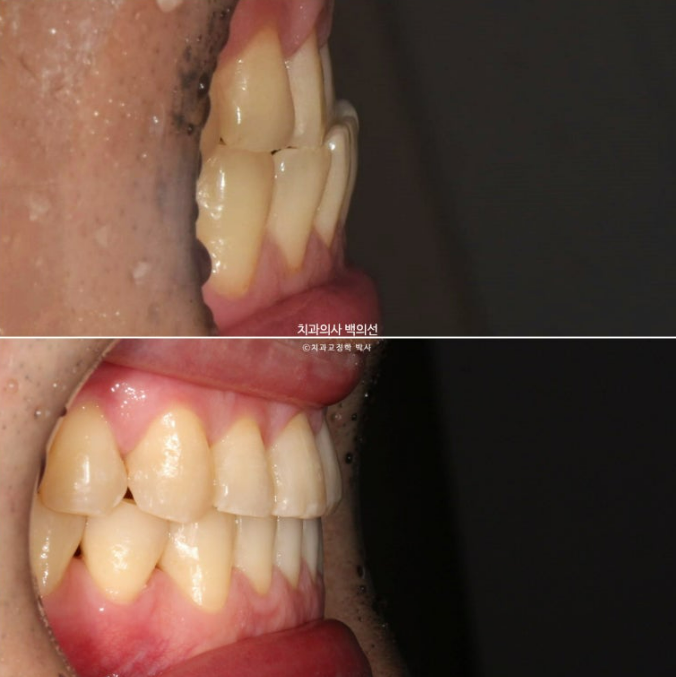 40대 인비절라인 비수술 비발치 주걱턱 비대칭 교정 관련 이미지 15