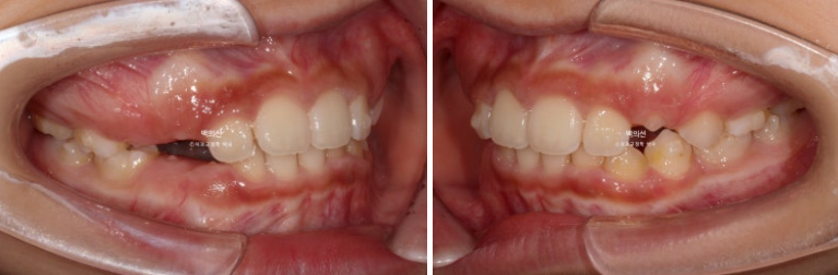 인비절라인퍼스트 어린이 투명교정 과개교합 덧니 악궁확장 돌출 관련 이미지 8