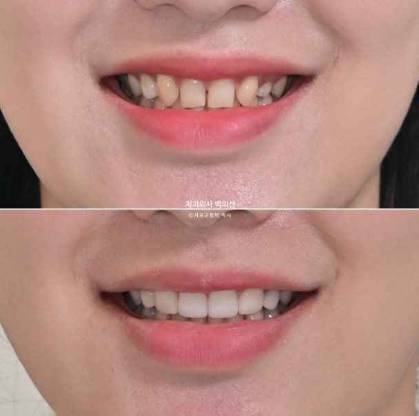 앞니 선천적 결손 벌어짐 잔존 유치 무삭제 라미네이트 관련 이미지 1