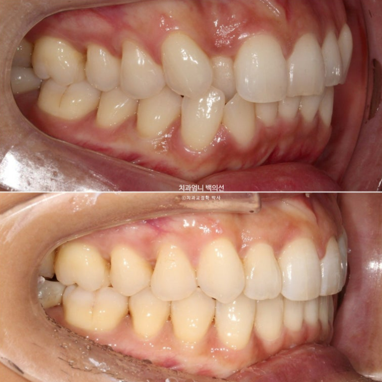 인비절라인 비발치 덧니 교정 반대교합 치료 후기 관련 이미지 17