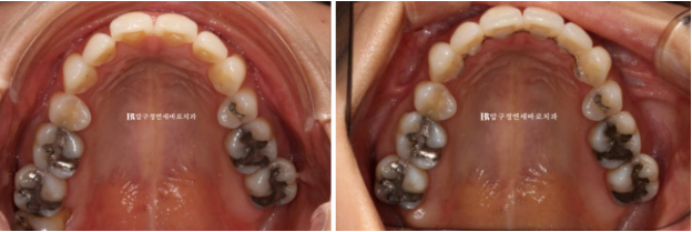 블랙트라이앵글 없애는 교정 가능할까요? 재교정 단기교정 후기 관련 이미지 10