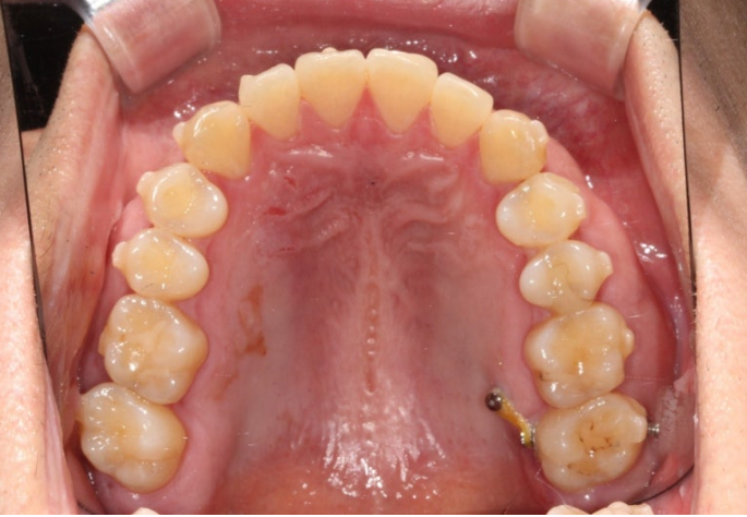 가위교합 벌어짐 중심선 과개교합 인비절라인 라이트 교정 관련 이미지 10