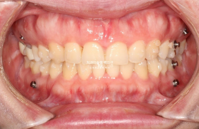 비발치 덧니 교정 인비절라인 과개교합 교정 무삭제 라미네이트 치료 후기 관련 이미지 12