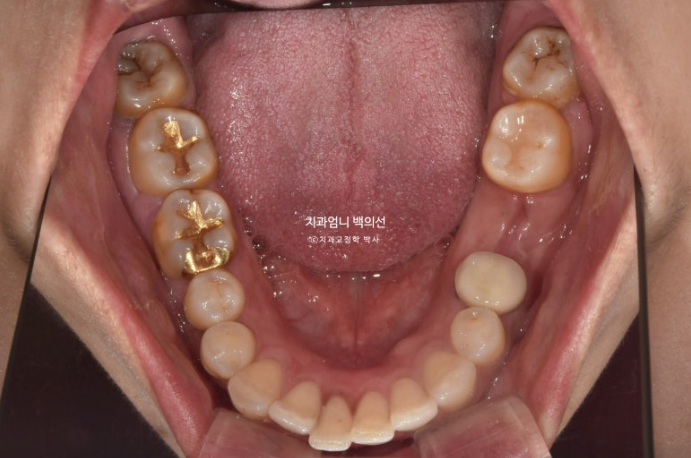 40대 인비절라인 라이트 앞니 벌어짐 뻗침 돌출 치료 관련 이미지 6