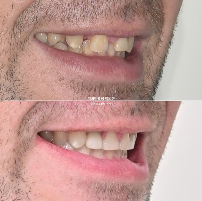 앞니 선천적 결손 인비절라인 임플란트 과개교합 치료 기간 관련 이미지 30