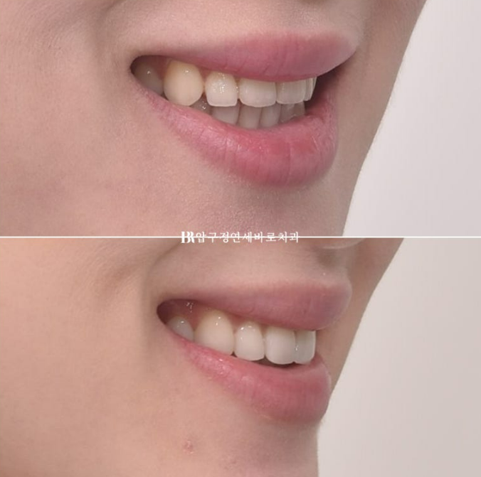 스마일라인 개선 무삭제 라미네이트 실제 두께 ? 관련 이미지 14