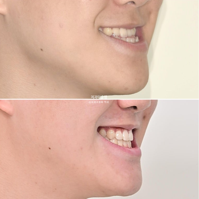 비수술 비발치 주걱턱 절충치료 클리피씨 개방교합 반대교합 치료 관련 이미지 1