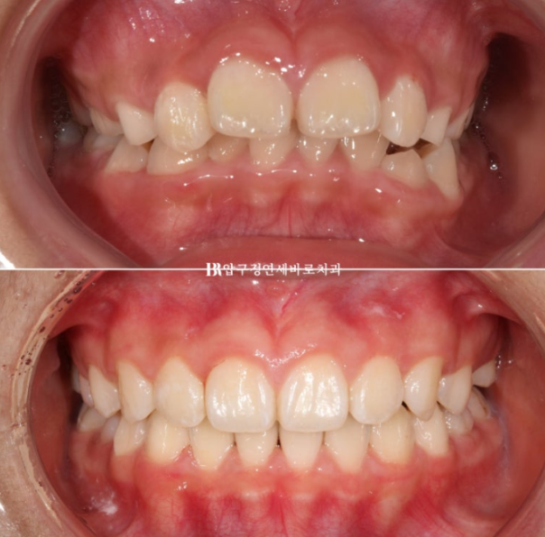 압구정 어린이교정 인비절라인 퍼스트 악궁확장 덧니 교정 관련 이미지 11