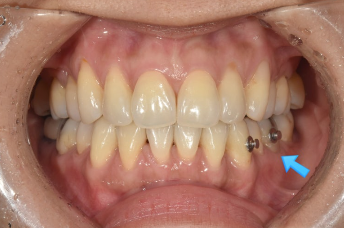 How Can Black Triangles Be Removed? Is Re-treatment Orthodontics an Option? image 5