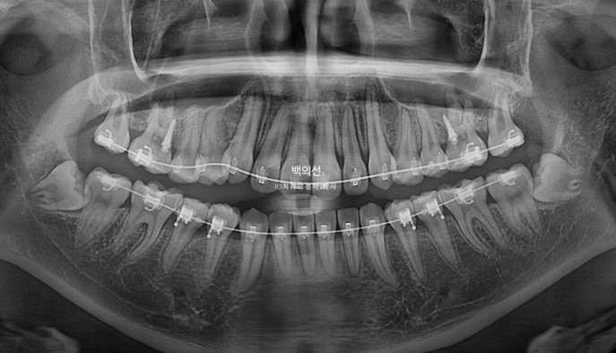 비발치 덧니교정 인비절라인 교정 사랑니 이용 교정 관련 이미지 12