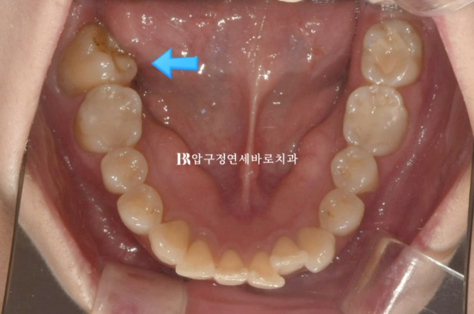Invisalign Lite for Orthodontic Treatment in Your 40s: Crossbite and Protrusive Mouth Correction image 6