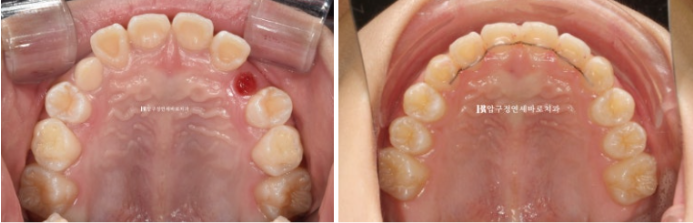 Simultaneous Arch Expansion and Teeth Alignment for Elementary School Children with Invisalign｜Invisalign First image 14