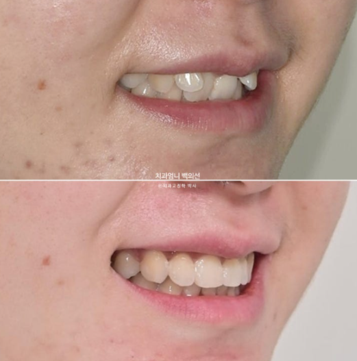 Inward-Tilted Teeth Orthodontic Treatment Review | A Real Case of Treating Congenitally Missing Lower Incisor (Three Lower Front Teeth) Without Extractions image 15