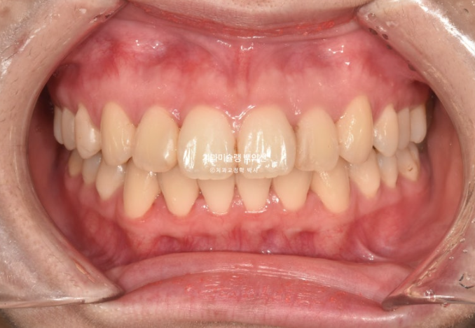 돌출입 인비절라인 발치교정 거미스마일 잇몸미소 잇몸돌출 입술부전증 무턱 재교정 관련 이미지 2