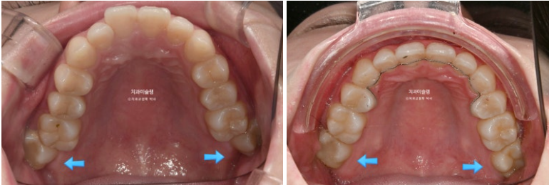 심한 돌출입 입술부전증 호두주름 발치교정 치료 관련 이미지 12