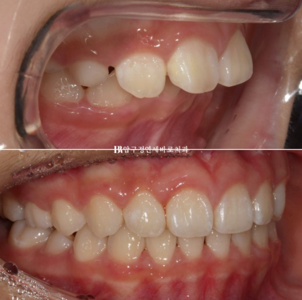 압구정 어린이교정 인비절라인 퍼스트 악궁확장 덧니 교정 관련 이미지 14