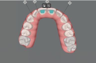 인비절라인라이트 덧니 과개교합 교정 치료기간 9개월 관련 이미지 7