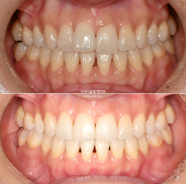 인비절라인 익스프레스 재교정 블랙트라이앵글 치간 삭제 치료기간 6개월 재제작 1회 관련 이미지 14