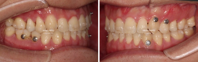 MSE 악궁확장 인비절라인 주걱턱 교정 비수술 관련 이미지 13
