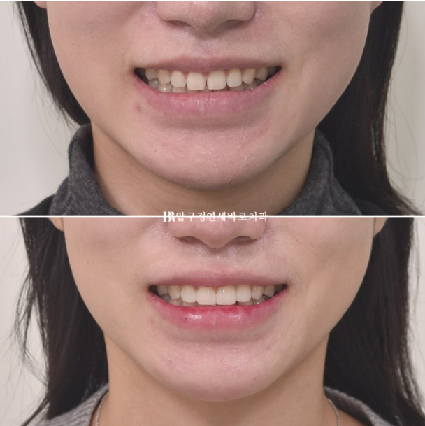 If Your Front Teeth Look Spaced Due to Peg-Shaped Teeth or Microdontia: A Case Choosing No-Prep Veneers Instead of Orthodontic Treatment image 9