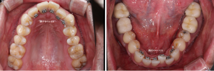 안보이는 앞니 교정 2D 교정 부분교정 후기 / 교정 시 잇몸이 더 나빠지지 않을까요? 관련 이미지 3